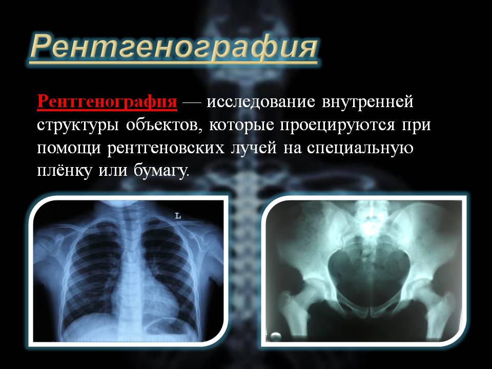 Это рентгенография с уменьшенным размером изображения получаемого на флюоресцирующем экране